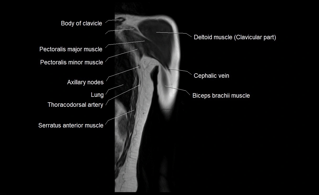 MRI upper arm (humerus ) coronal cross sectional anatomy image 3.webp